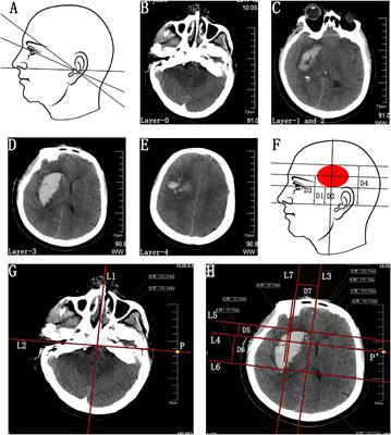 Individualized CT image-guided free-hand catheter technique: A new and reliable method for minimally invasive evacuation of basal ganglia hematoma